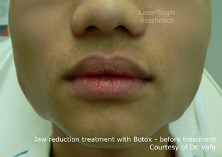 jaw reduction with Botox results before brooklyn